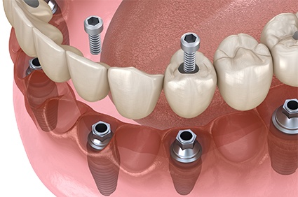 All on 4 Dental Implants in Jamaica Plain, Boston, MA