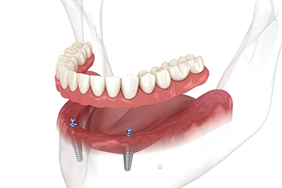 Factors Influencing Dental Implant Longevity